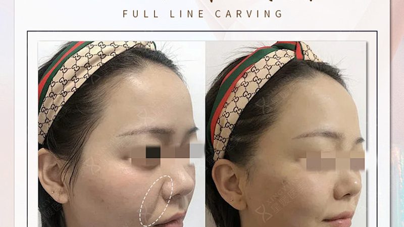超声炮：揭秘热门医美设备背后的品牌选择**