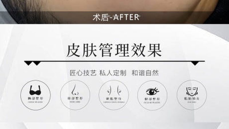 成都热玛吉美容仪：家用神器还是鸡肋？揭秘选购攻略