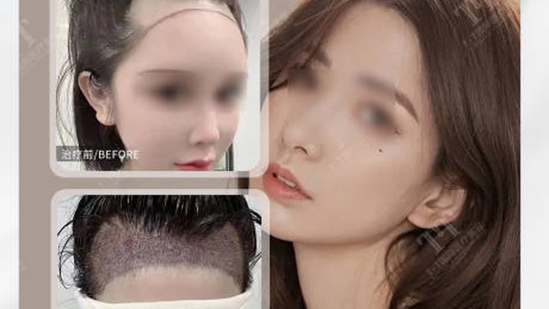 效果评估：瘦脸贴片的有效性