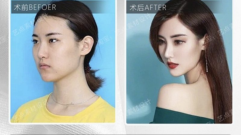 注射隆鼻与手术隆鼻失败案例对比解析