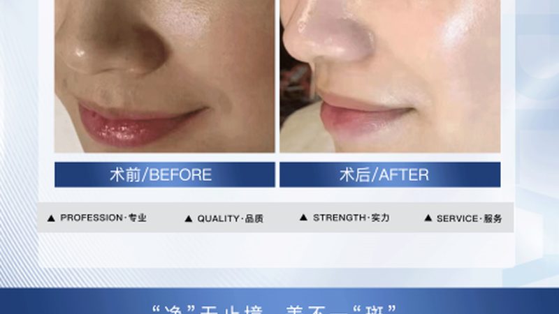 肉毒素厂家直供：揭秘价格背后的真相