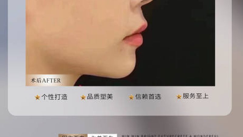 IPL激光祛斑仪操作步骤详解，掌握祛斑新技能
