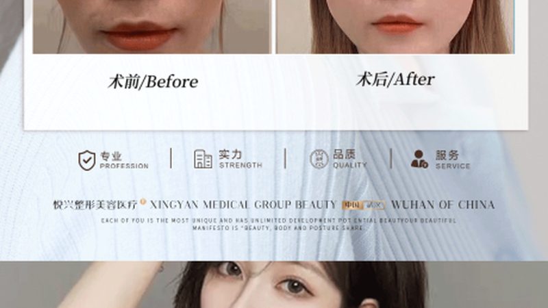 热玛吉与光子嫩肤：效果维持时间揭秘