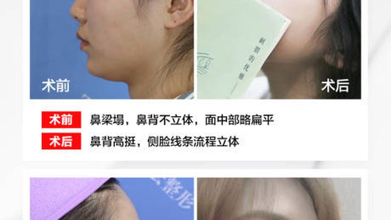 上海打瘦脸针，揭秘适合哪些人群