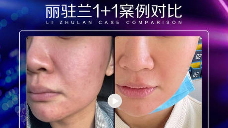 注射美容，这些禁忌症你了解吗？**